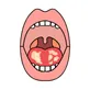 Oral Cancer Surgery